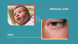Comparison of baby acne and milia on infant skin.